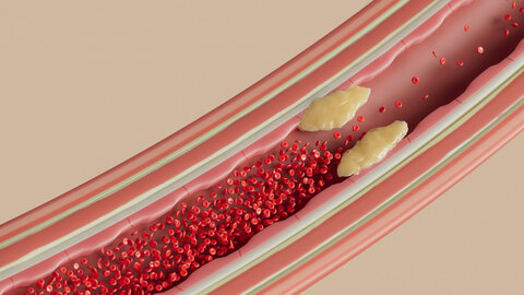 Illustration of a blood vessel with red blood cells and plaque on the vessel walls